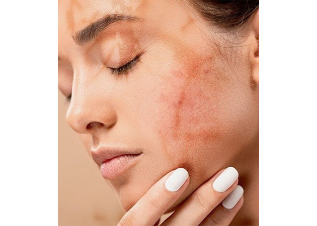 The Right Skincare Habits to Fight Acne